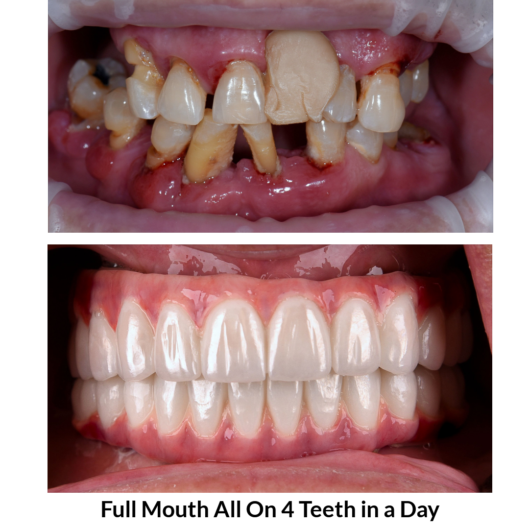 Full Mouth All on 4 Teeth in a Day Photo