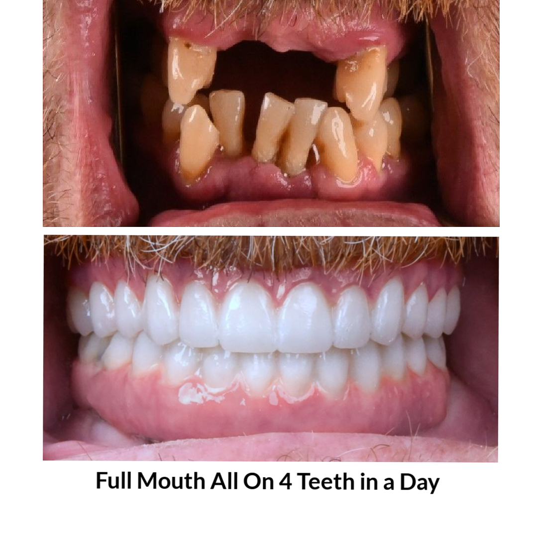 Full Mouth All on 4 Teeth in a Day Photo