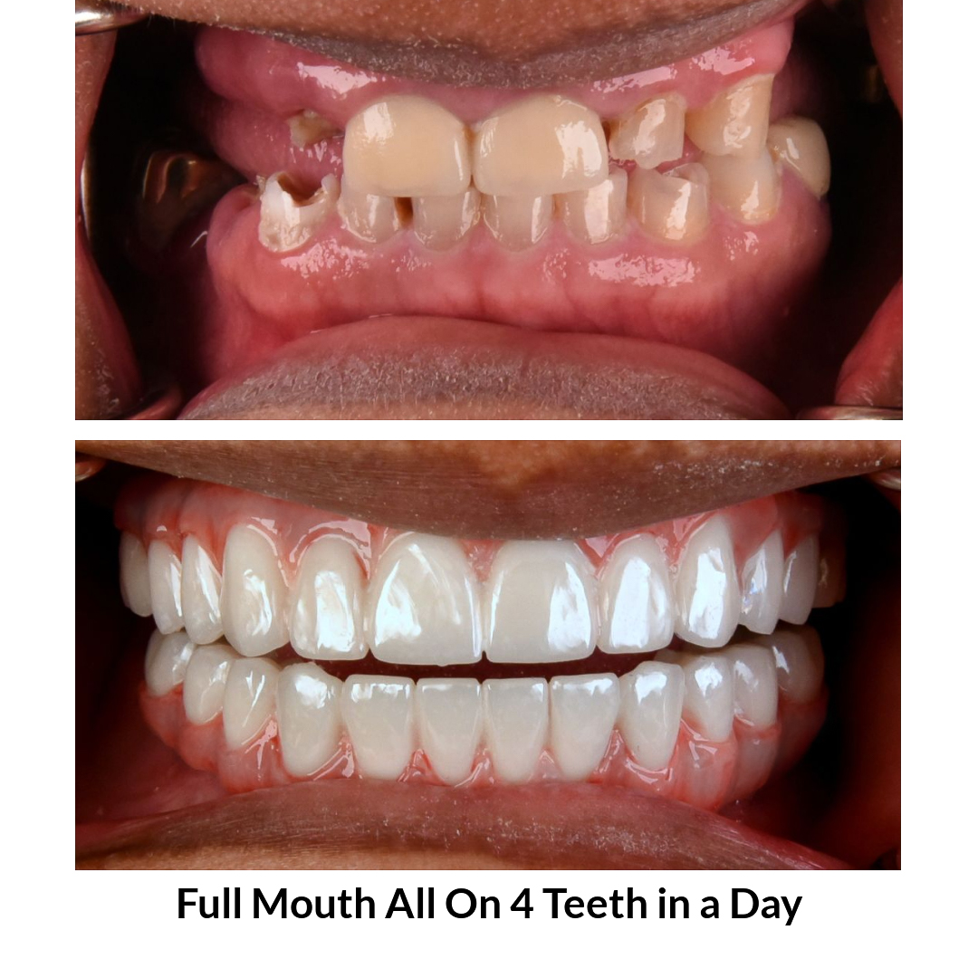 Full Mouth All on 4 Teeth in a Day Photo