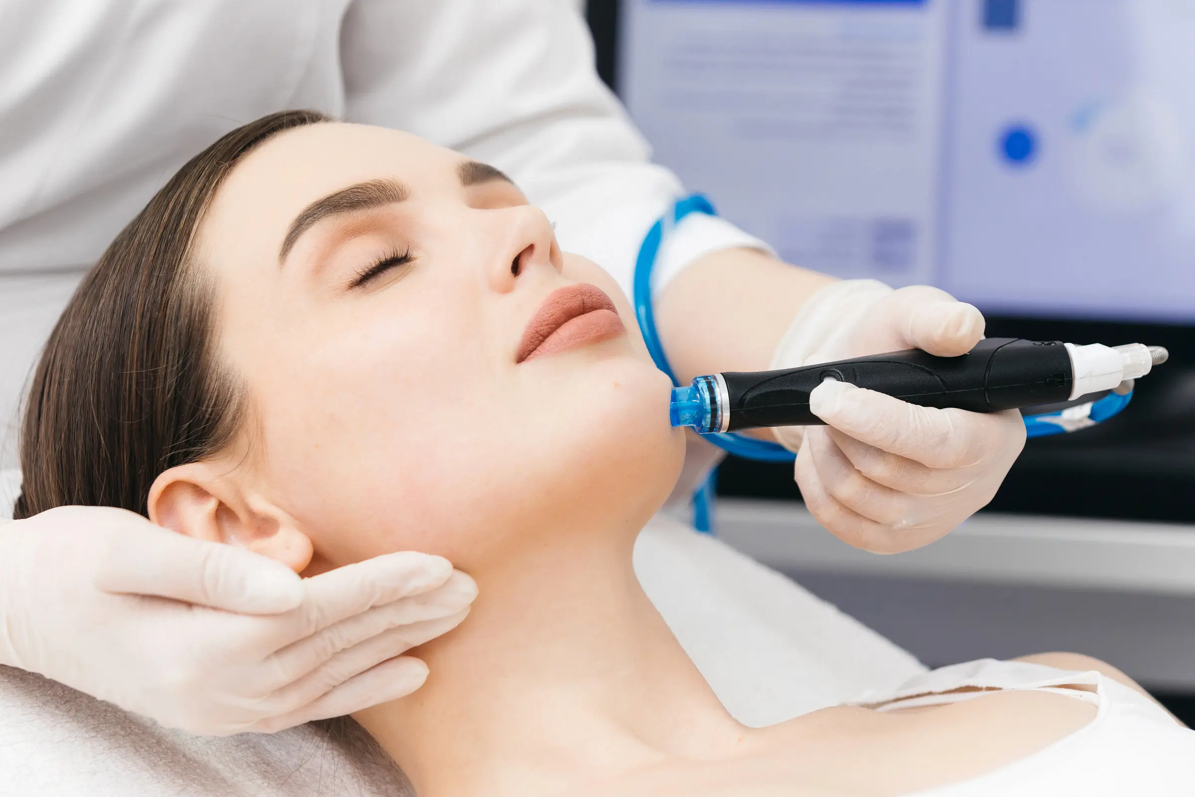 Microneedling PRP