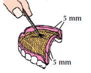 Bony Plus kit components including Separator gel