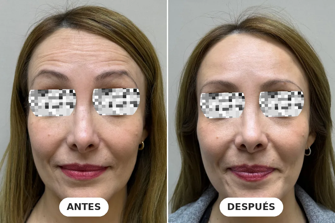 Antes y después de toxina botulínica en frente, paciente de 36 años