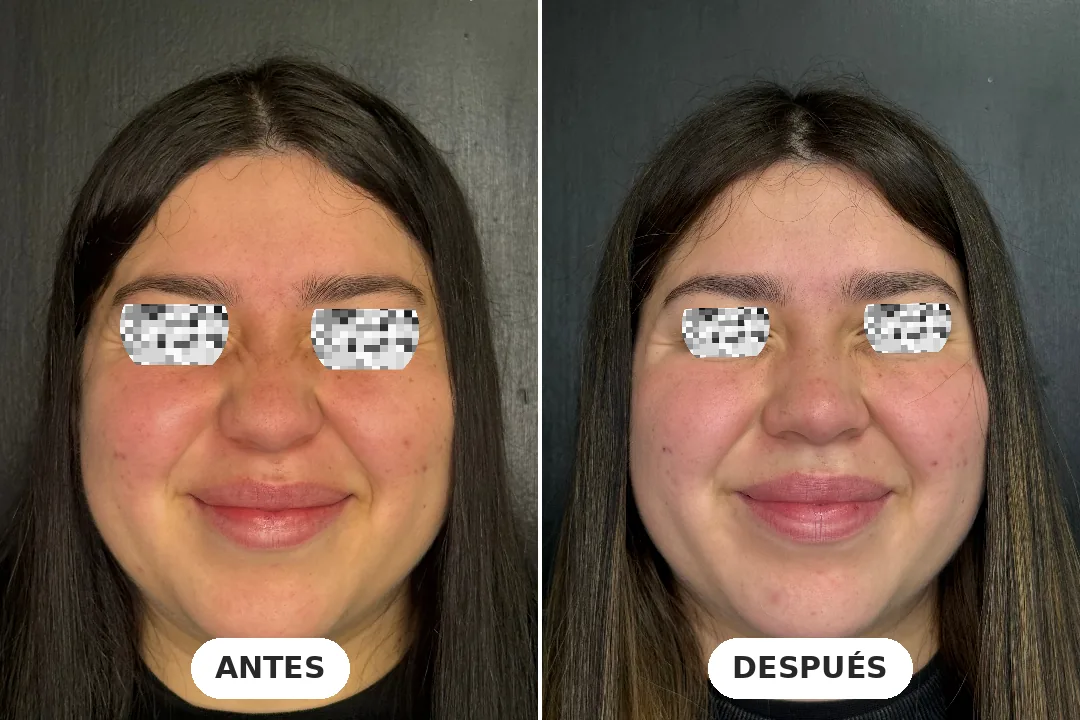 Antes y después de toxina botulínica en patas de gallo, paciente de 27 años