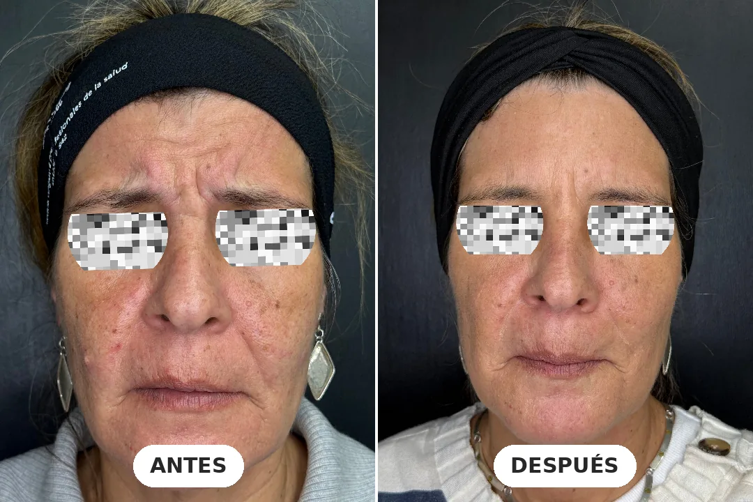 Antes y después de toxina botulínica en entrecejo, paciente de 55 años