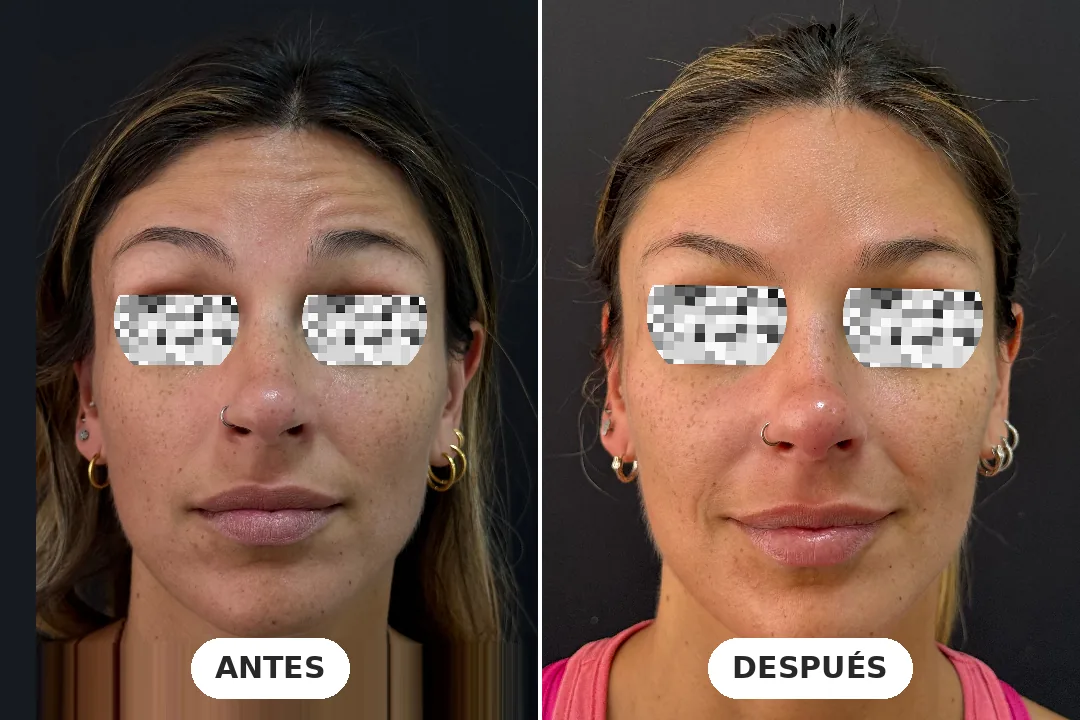 Antes y después de toxina botulínica en frente, paciente de 30 años