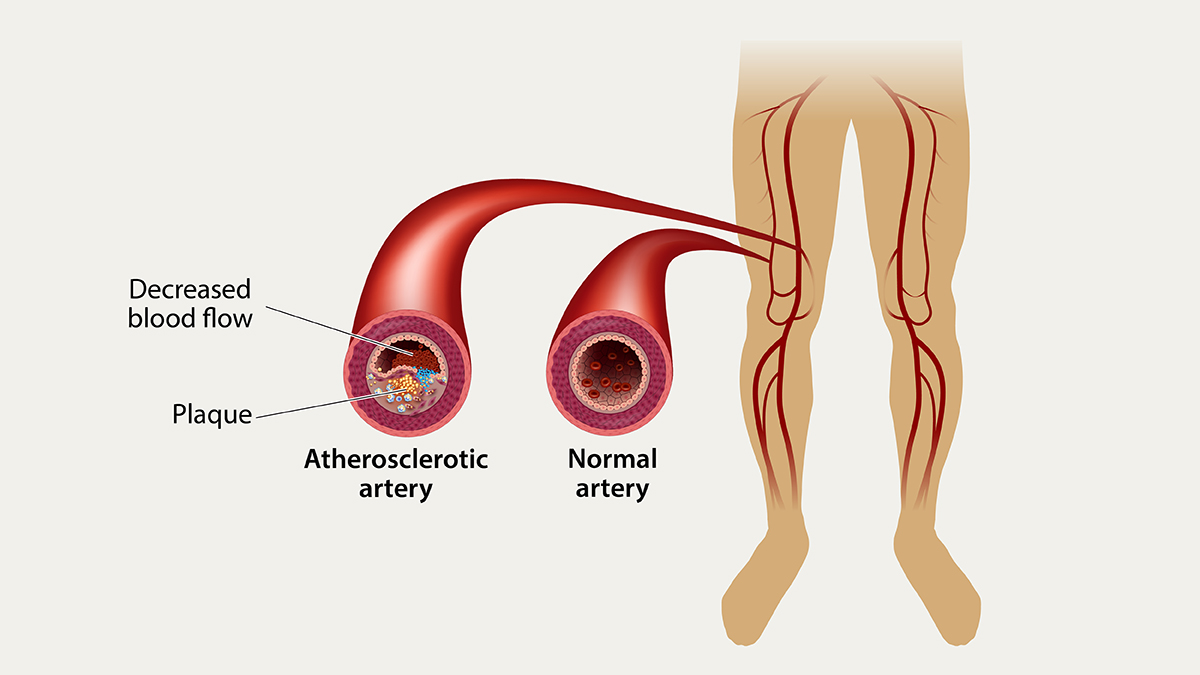Illustration comparing a normal artery with an atherosclerotic artery narrowed by plaque and decreased blood flow, next to a pair of legs showing the leg arteries.