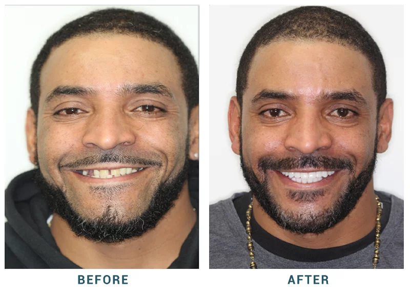 Before and After dental implants result 3