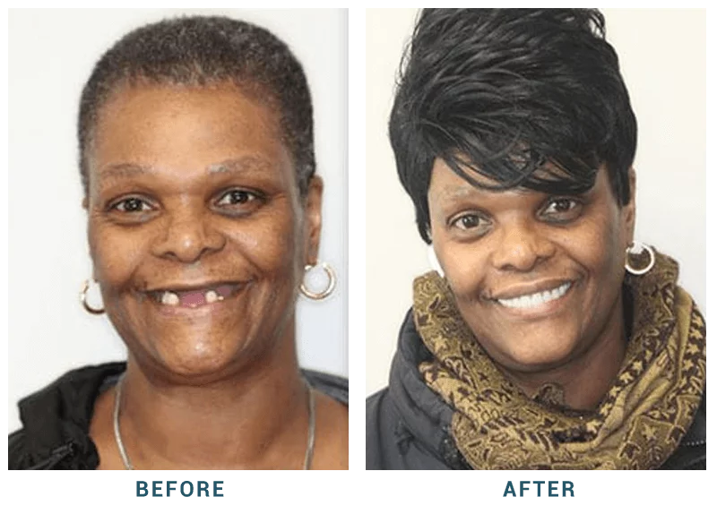 Before and After dental implants result 1