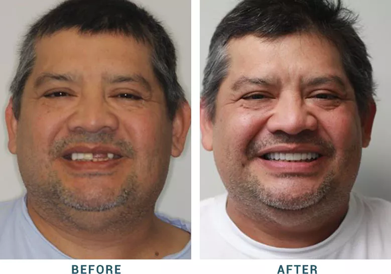 Before and After dental implants result 2