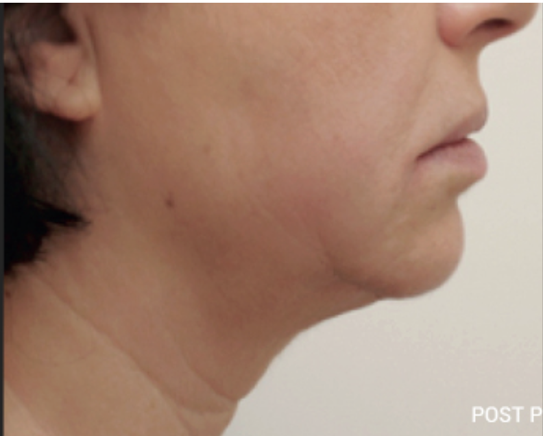 After HIFU skin tightening treatment