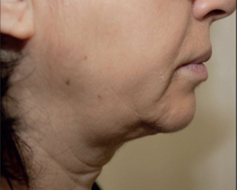Before HIFU skin tightening treatment