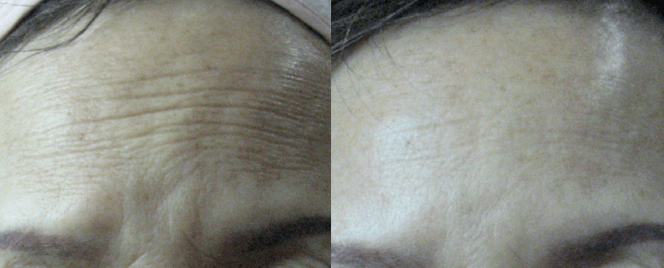 Neck tightening result