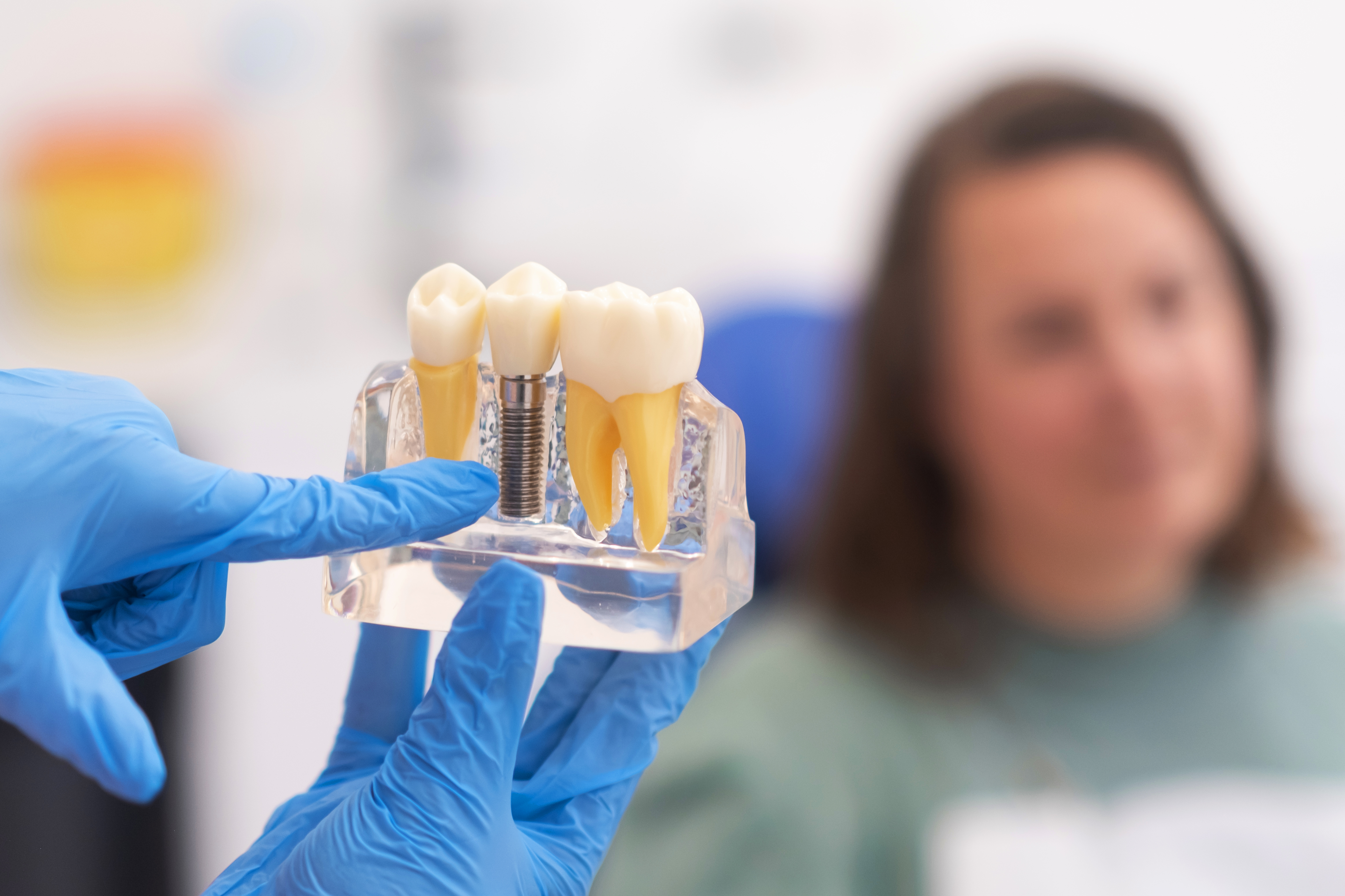 primo piano di un impianto dentale su modello anatomico della mascella — impianto-dentale-durata primo piano di un impianto dentale su modello anatomico della mascella — impianto-dentale-durata