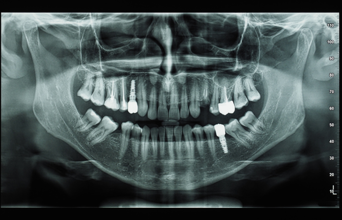 radiografia panoramica che mostra impianti dentali integrati nell'osso — radiografia-impianti-dentali radiografia panoramica che mostra impianti dentali integrati nell'osso — radiografia-impianti-dentali