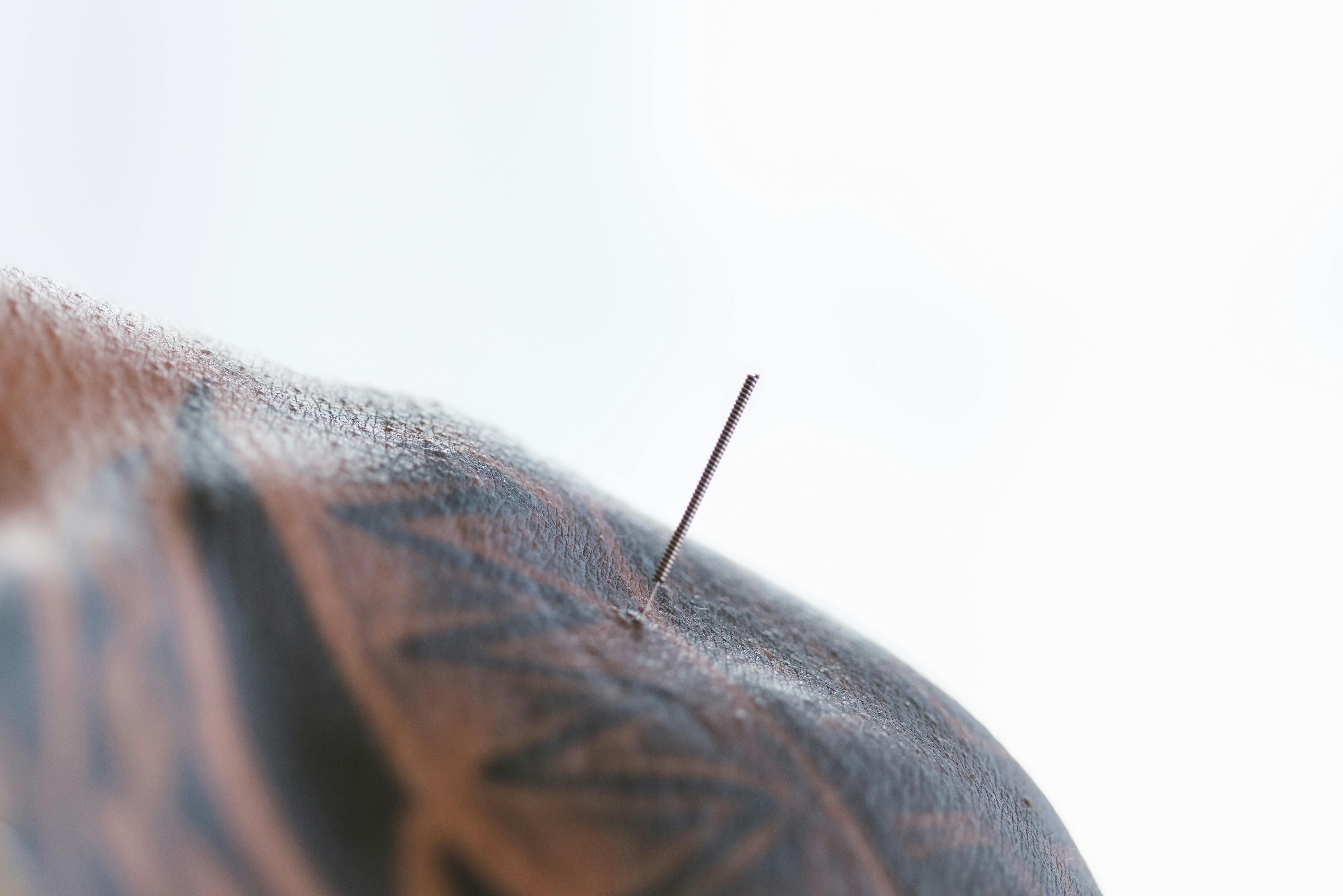 acupuncture image