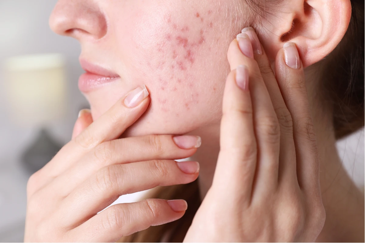 Close-up view of a woman touching her cheek displaying noticeable redness and depressed acne scarring Close-up view of a woman touching her cheek displaying noticeable redness and depressed acne scarring