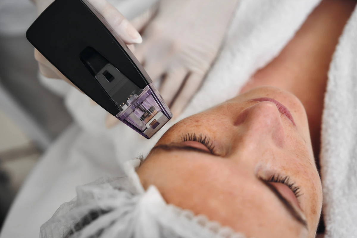 Top-down view of a medical aesthetician performing a Morpheus8 treatment on a patient's upper face Top-down view of a medical aesthetician performing a Morpheus8 treatment on a patient's upper face