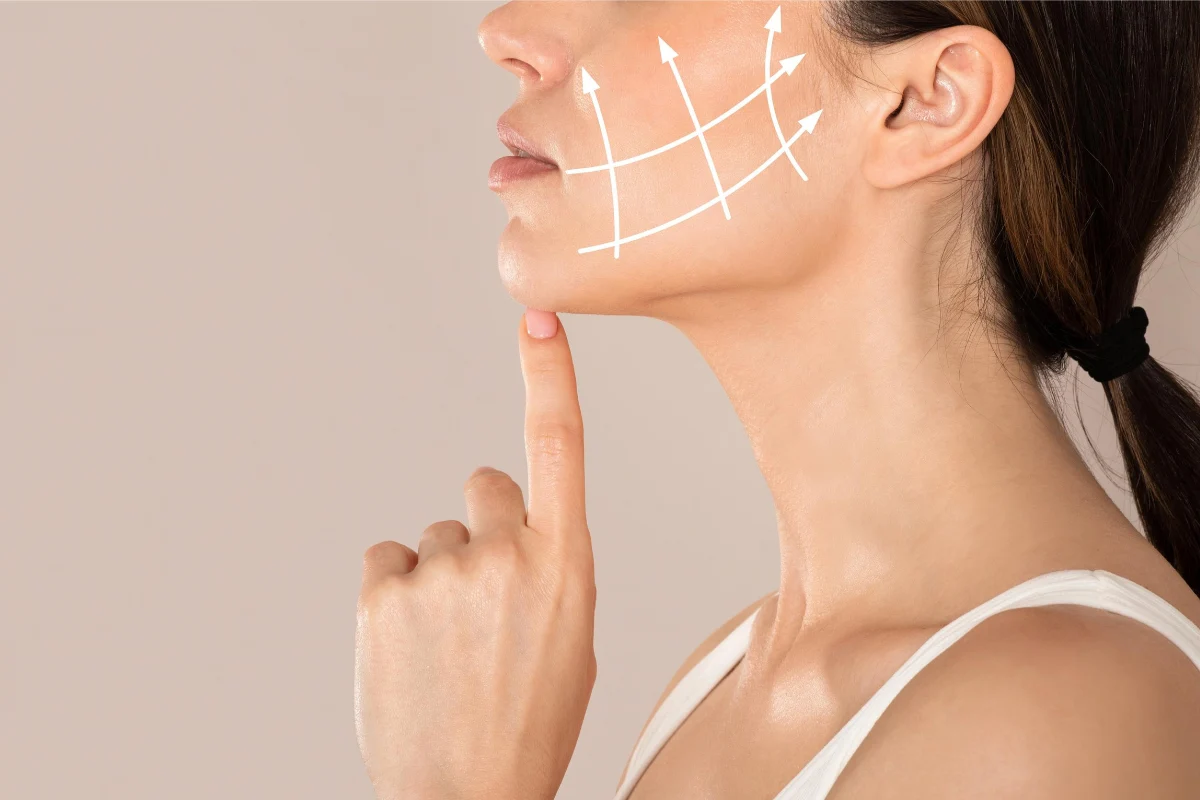 Diagram lines on patient lower face showing treatment areas for skin laxity and jawline contouring Diagram lines on patient lower face showing treatment areas for skin laxity and jawline contouring