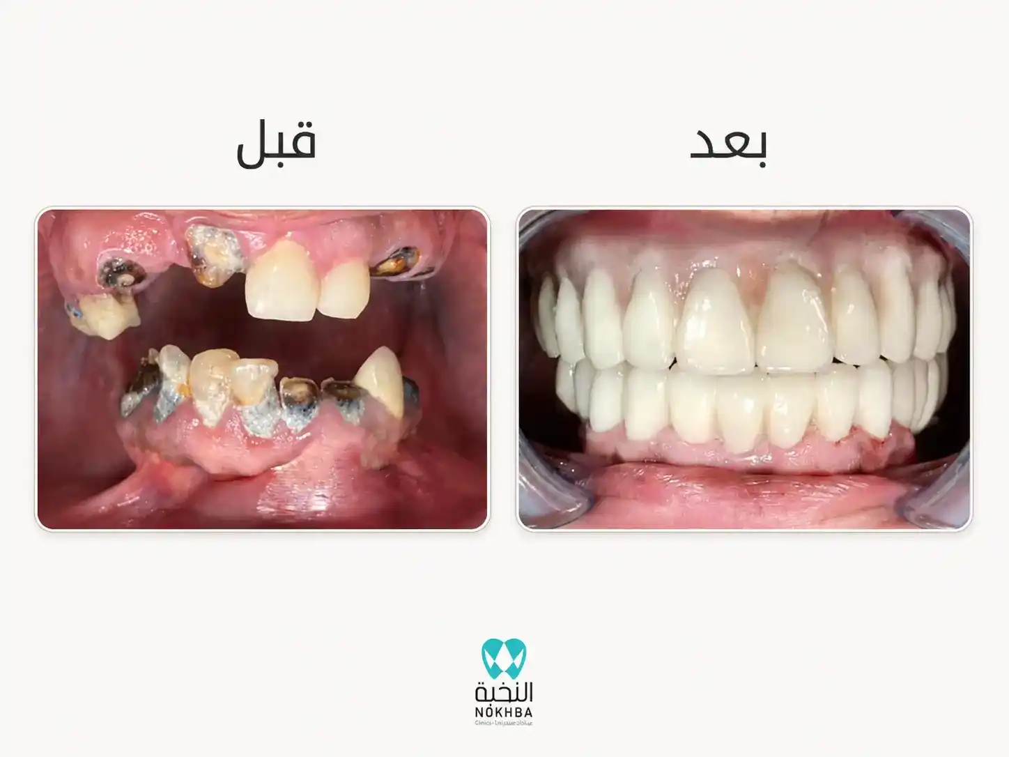 نتيجة زراعة الأسنان للحالة الثالثة