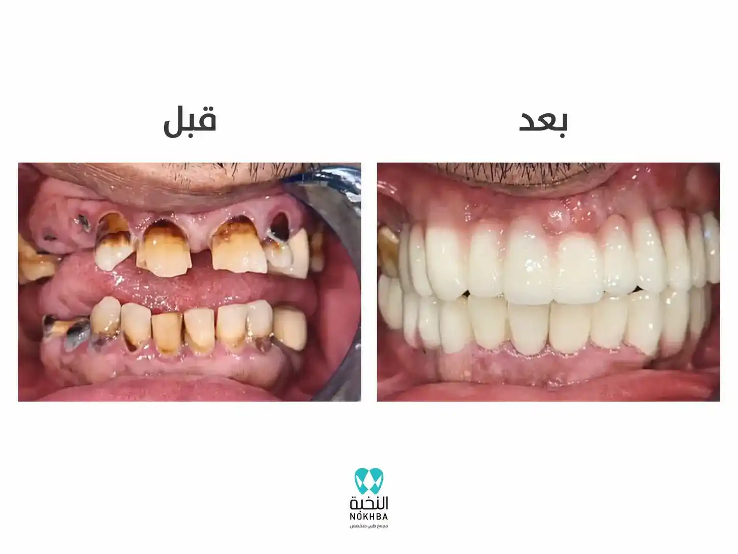 نتيجة زراعة الأسنان للحالة الثانية
