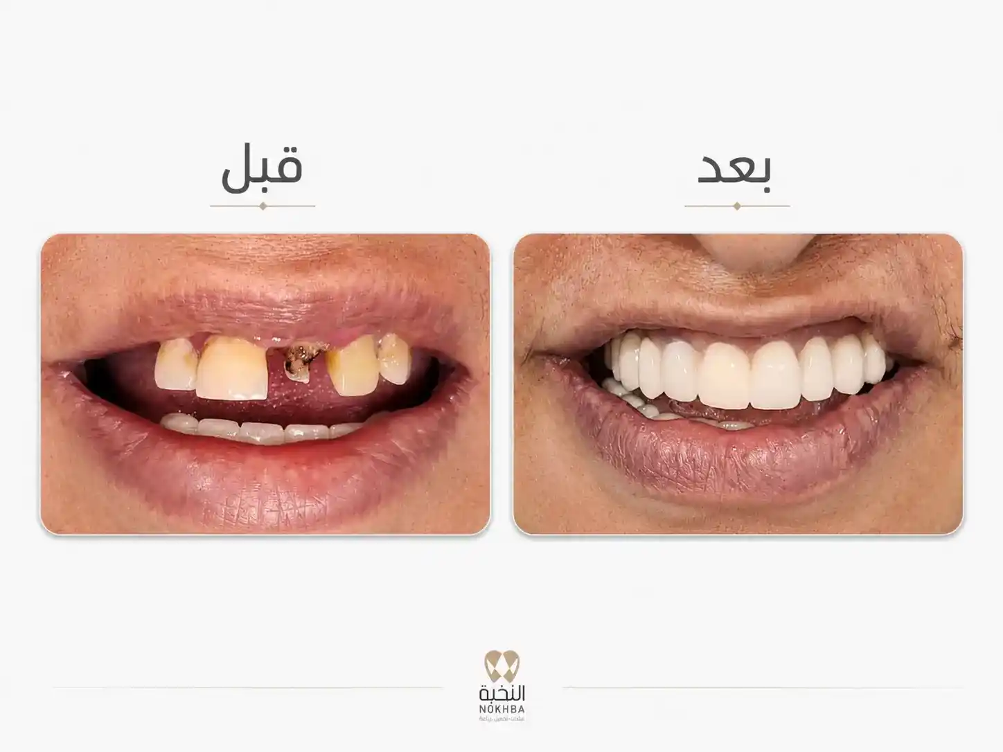 نتيجة زراعة الأسنان للحالة الأولى