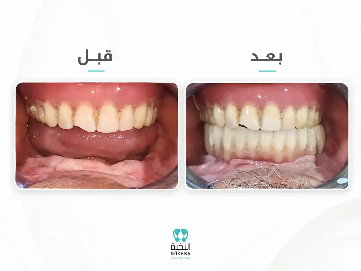 نتيجة زراعة الأسنان للحالة الرابعة