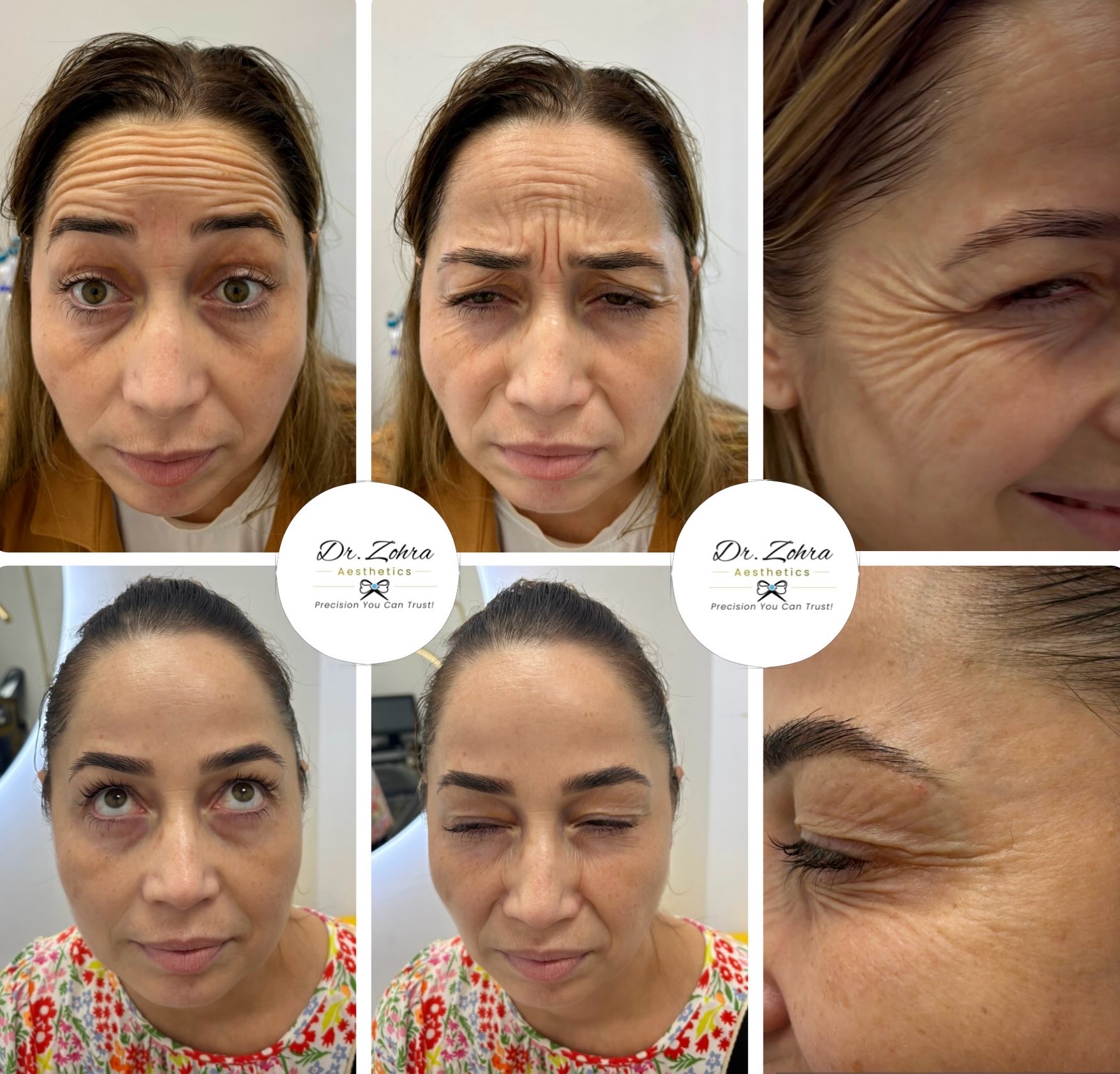 Facial anti-wrinkle before and after result by Dr Zohra
