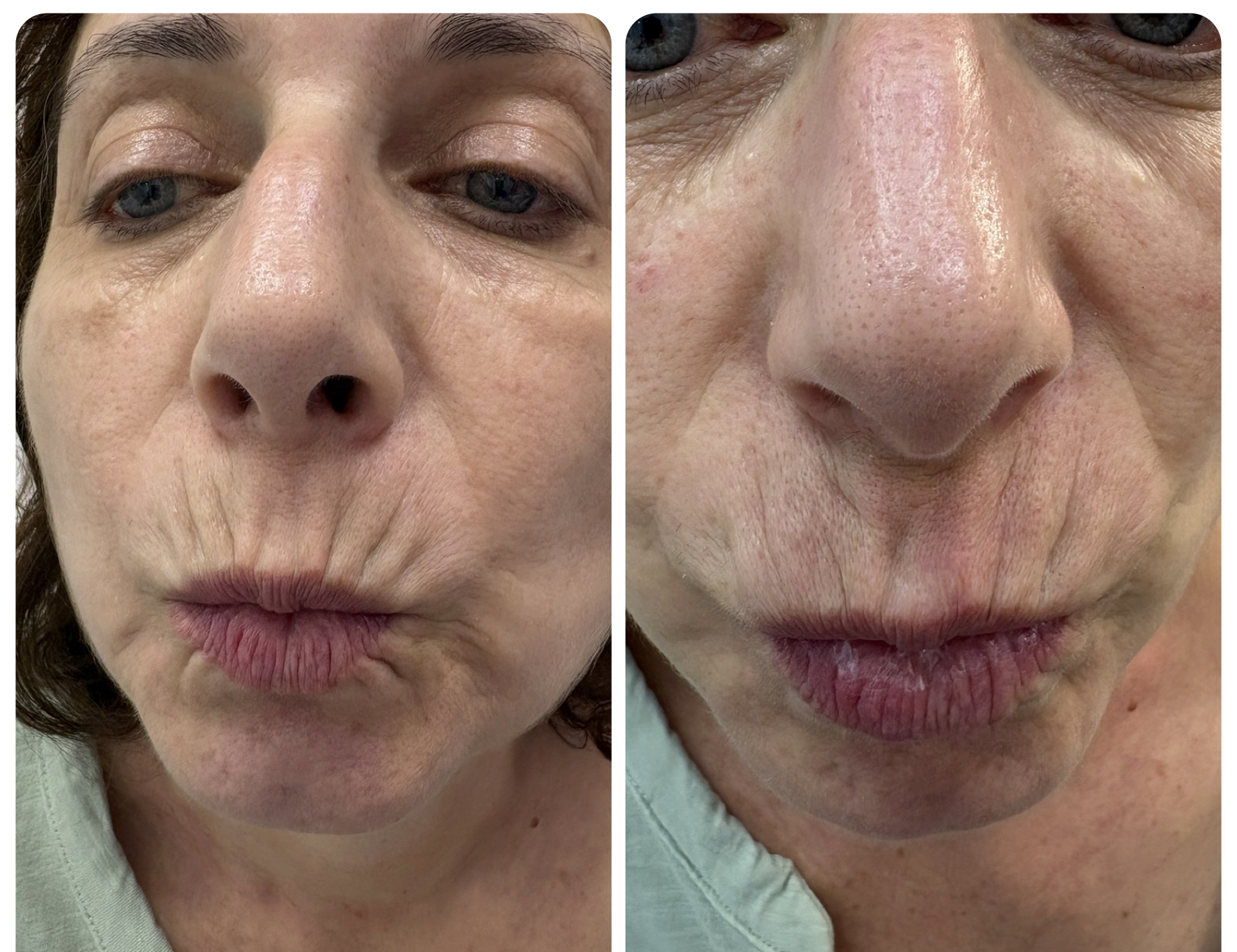 Facial line treatment before and after result by Dr Zohra