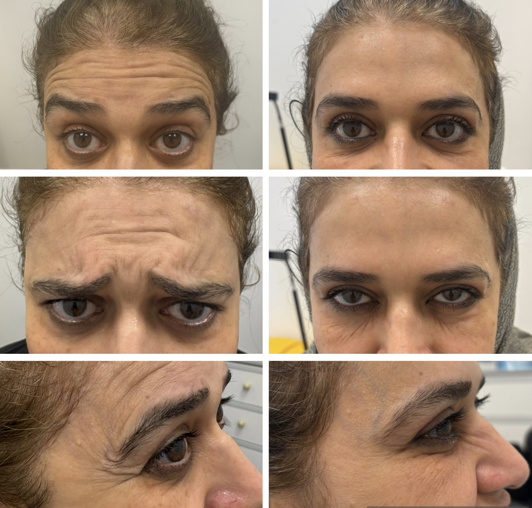 Forehead and facial lines before and after treatment by Dr Zohra