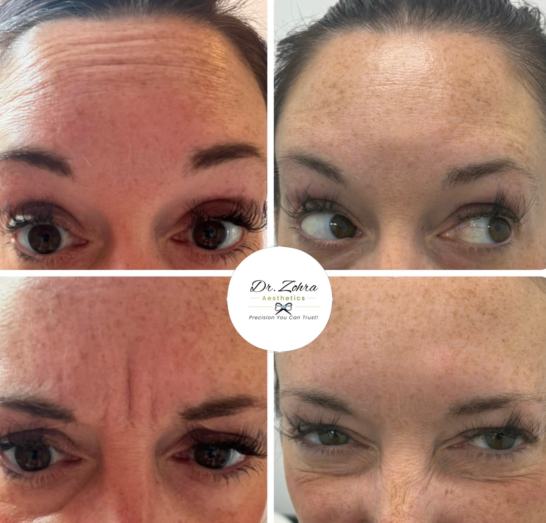 Before and after anti-wrinkle treatment result by Dr Zohra