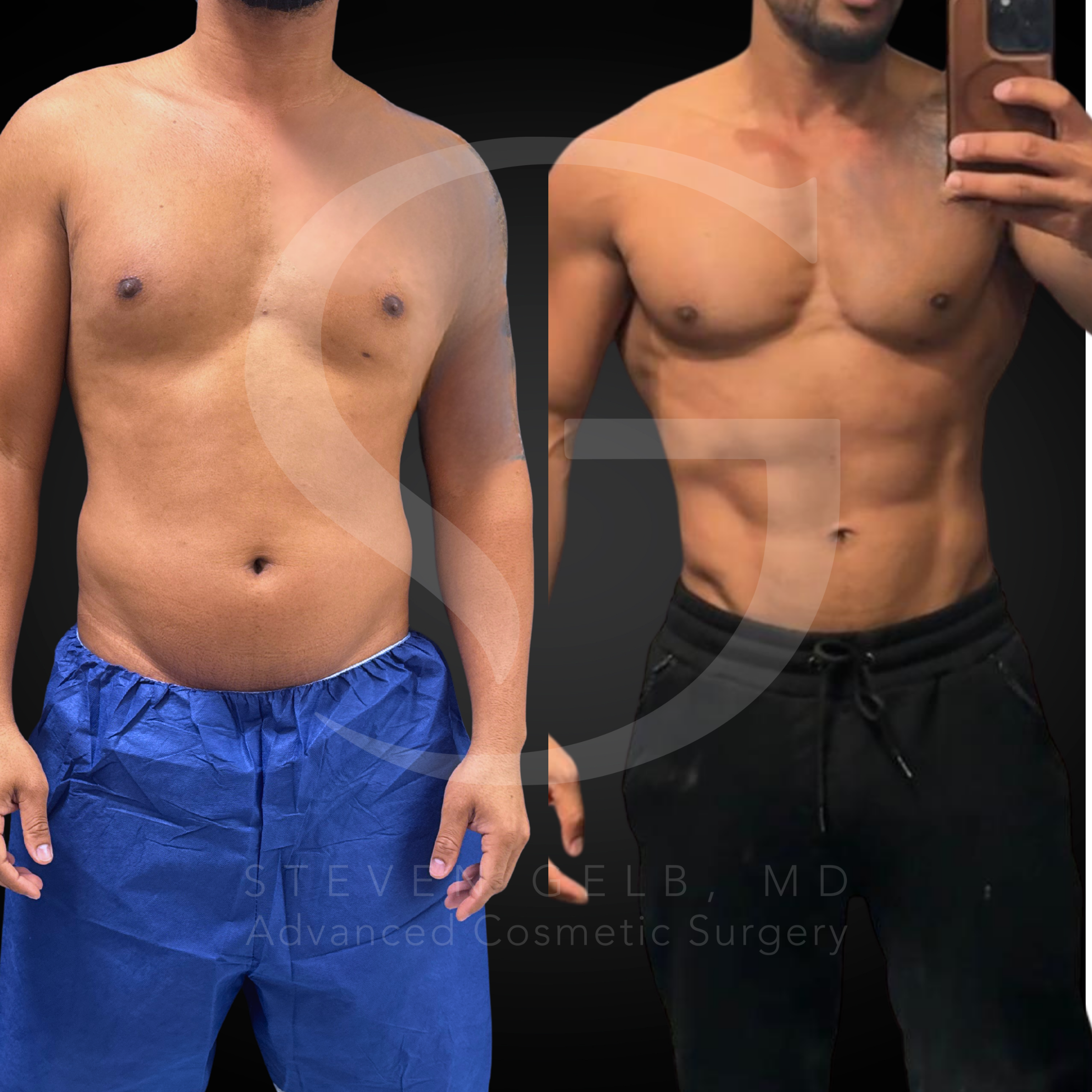 Male high-definition liposuction result