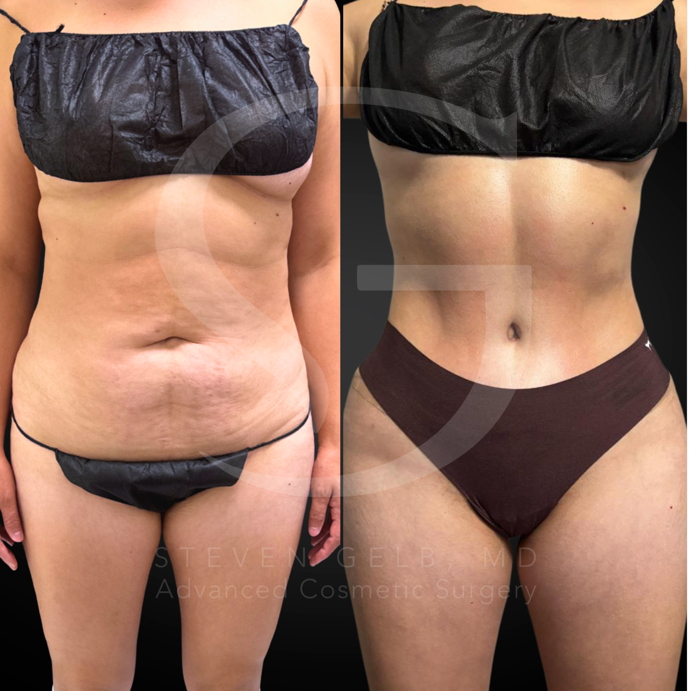 Abdominoplasty result