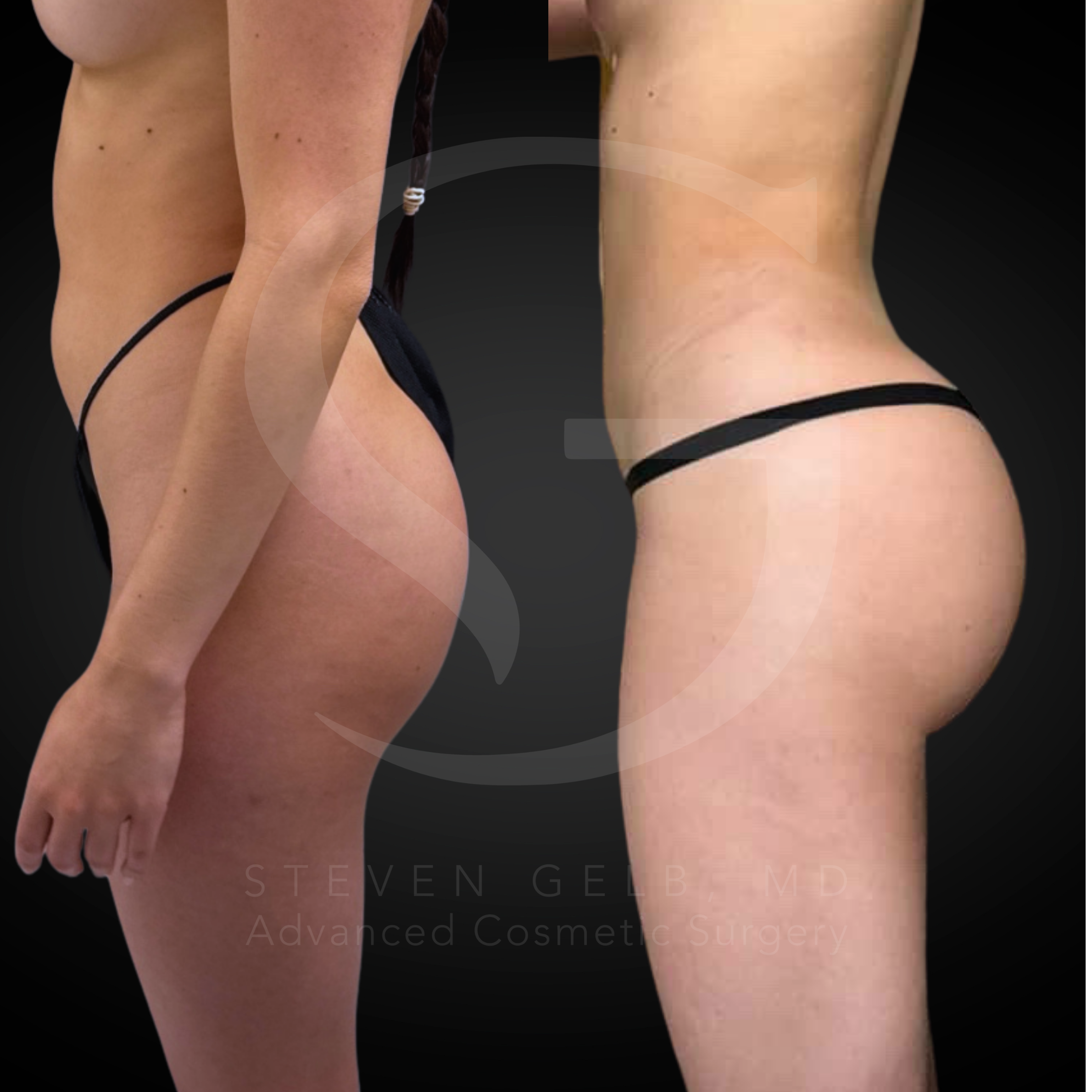 Brazilian Butt Lift result