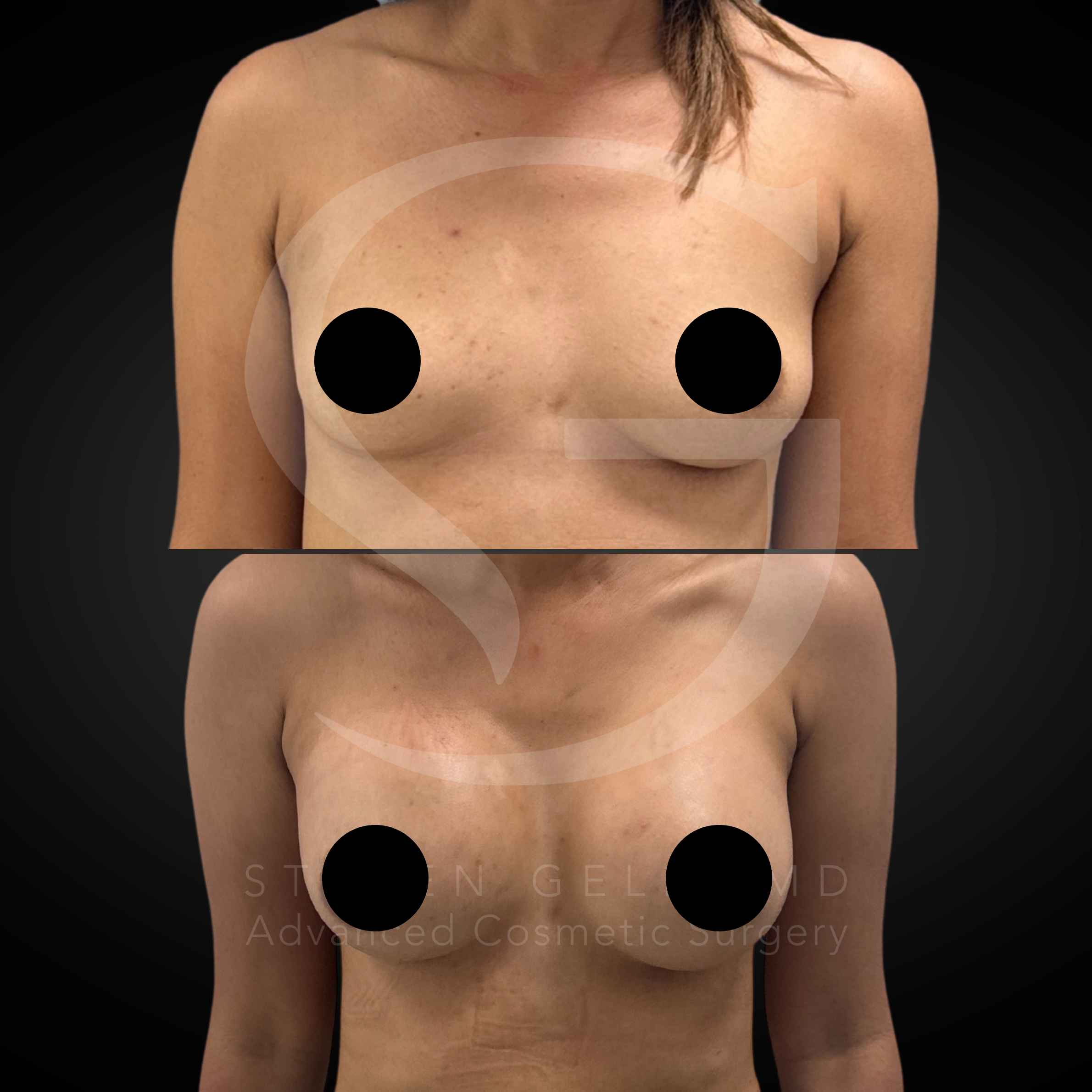 Breast augmentation result