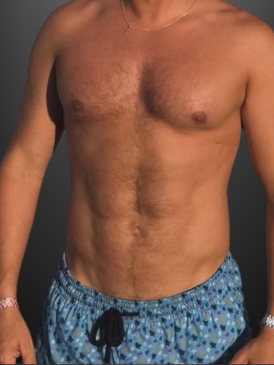 HD VASER Lipo + Chest — after result by Dr. Steven Gelb