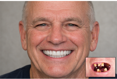 The image displays a male demonstrating bad teeth before receiving dental care and an image that represent beautiful teeth after receiving dental care.