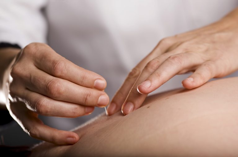 TCM Acupuncture