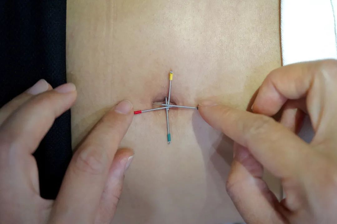 Tibetan Acupuncture