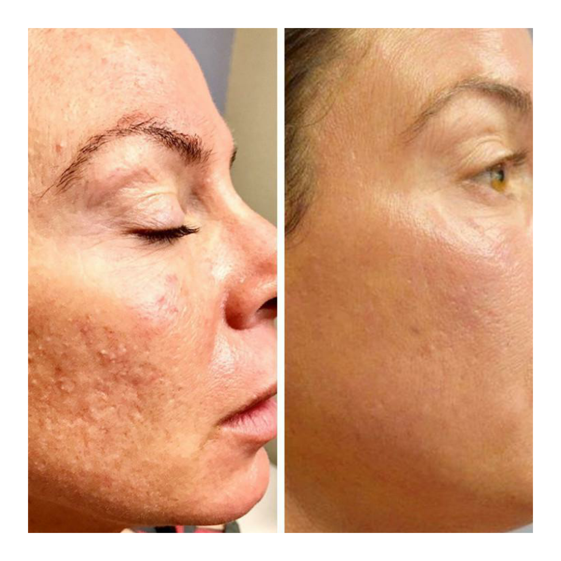 Before and after skin treatment showing improvement in pigmentation and sun damage