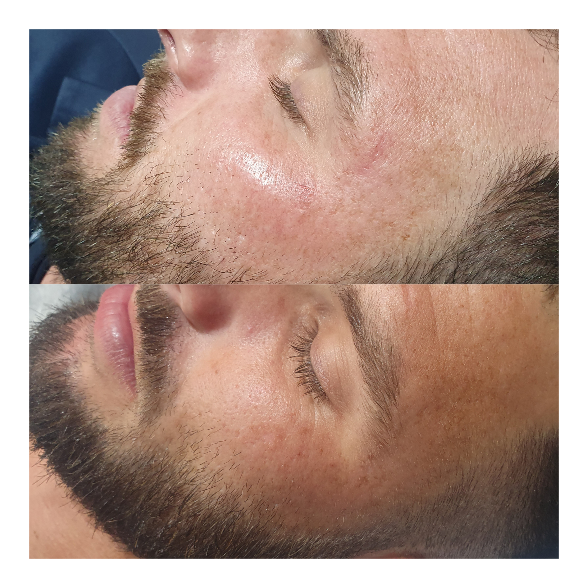 Before and after skin treatment showing improvement in skin texture and redness for male client