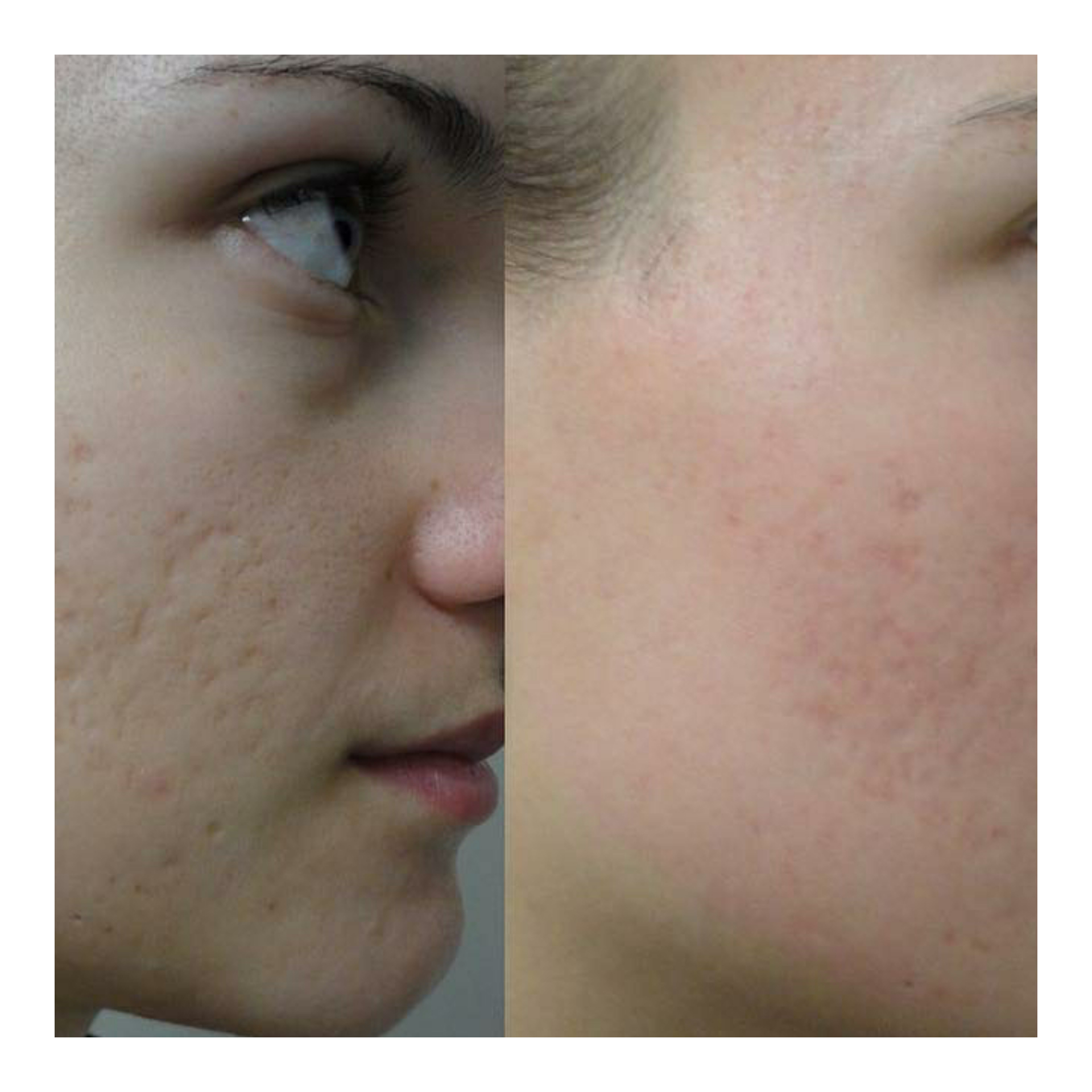 Before and after skin treatment showing improvement in acne scarring