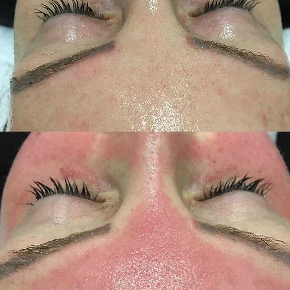 Skin needling results