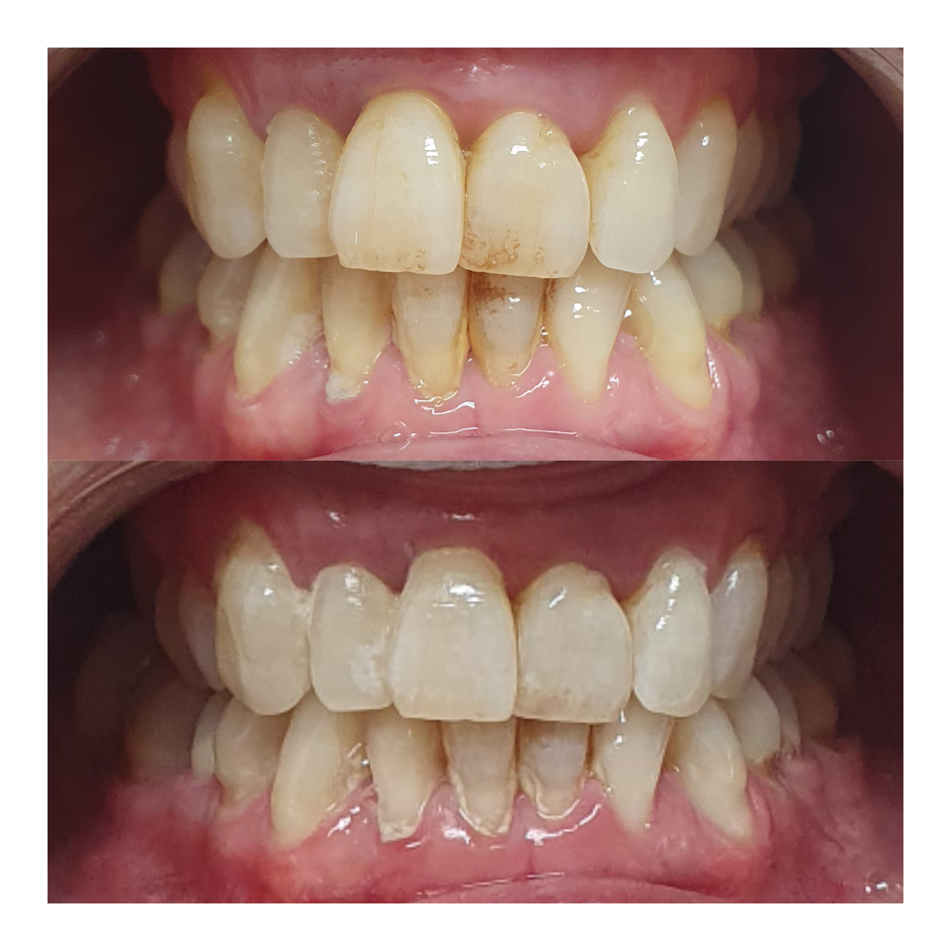 Teeth whitening result 6 at Looks by Brooke