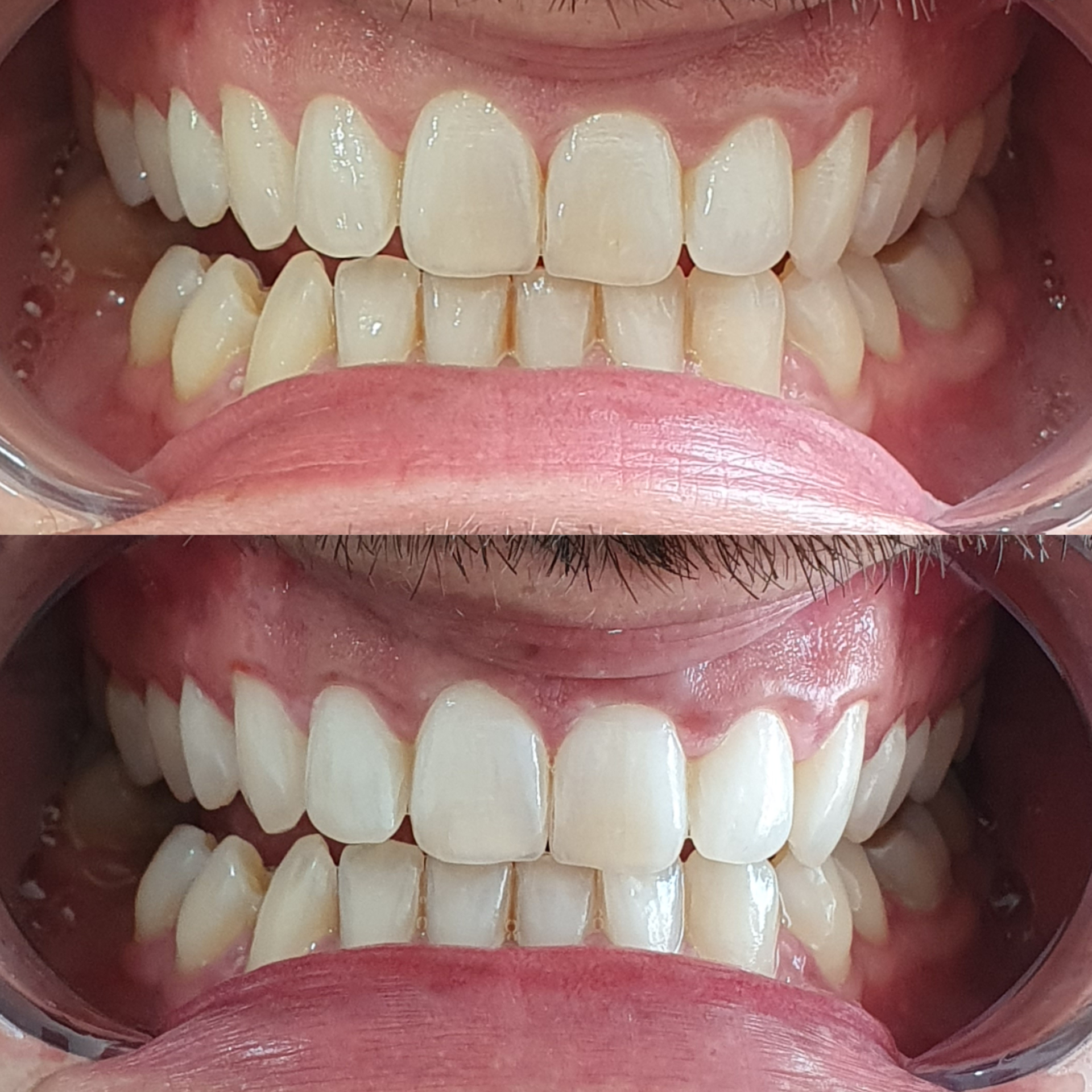 Teeth whitening result 4 at Looks by Brooke
