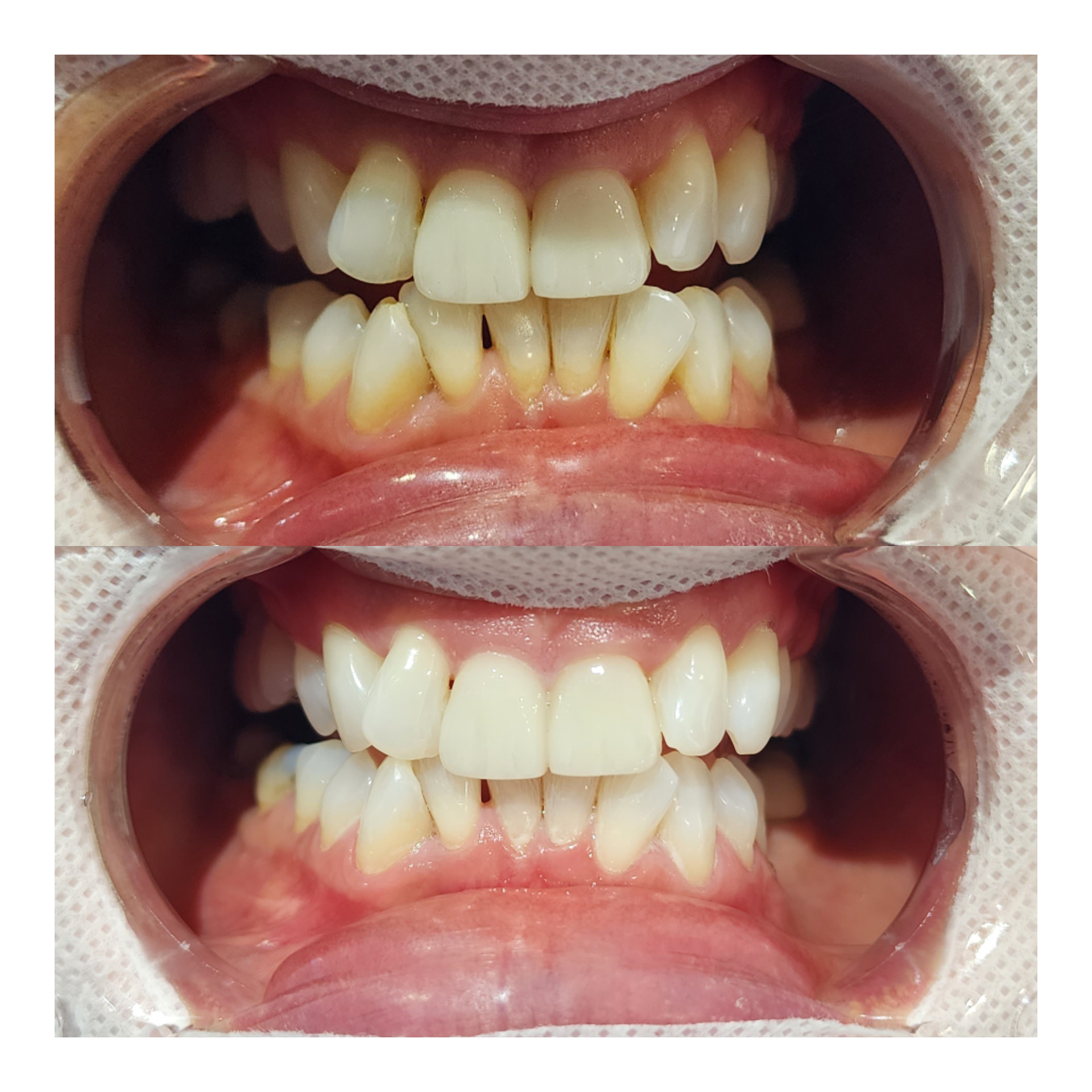 Teeth whitening result 5 at Looks by Brooke