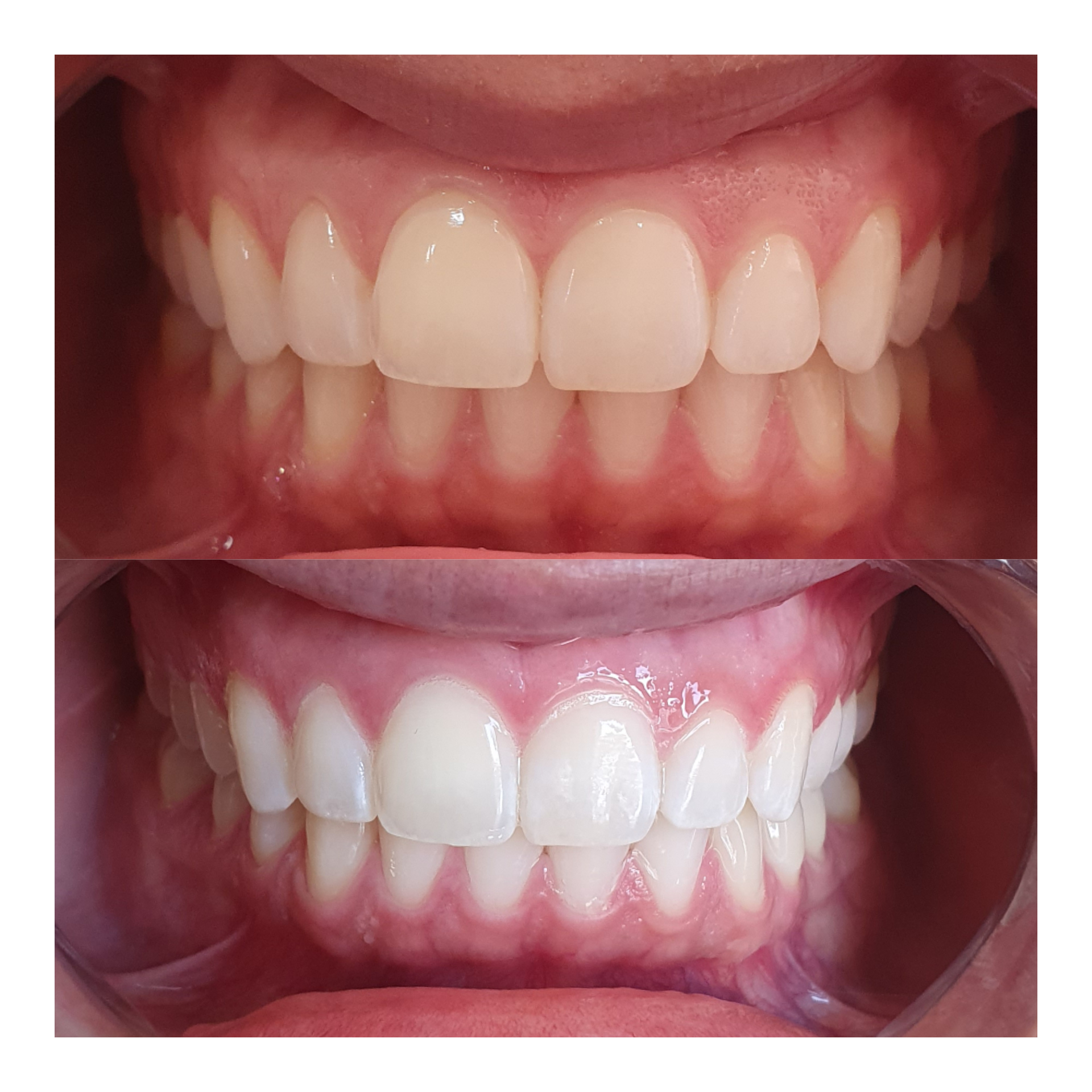 Teeth whitening result 7 at Looks by Brooke