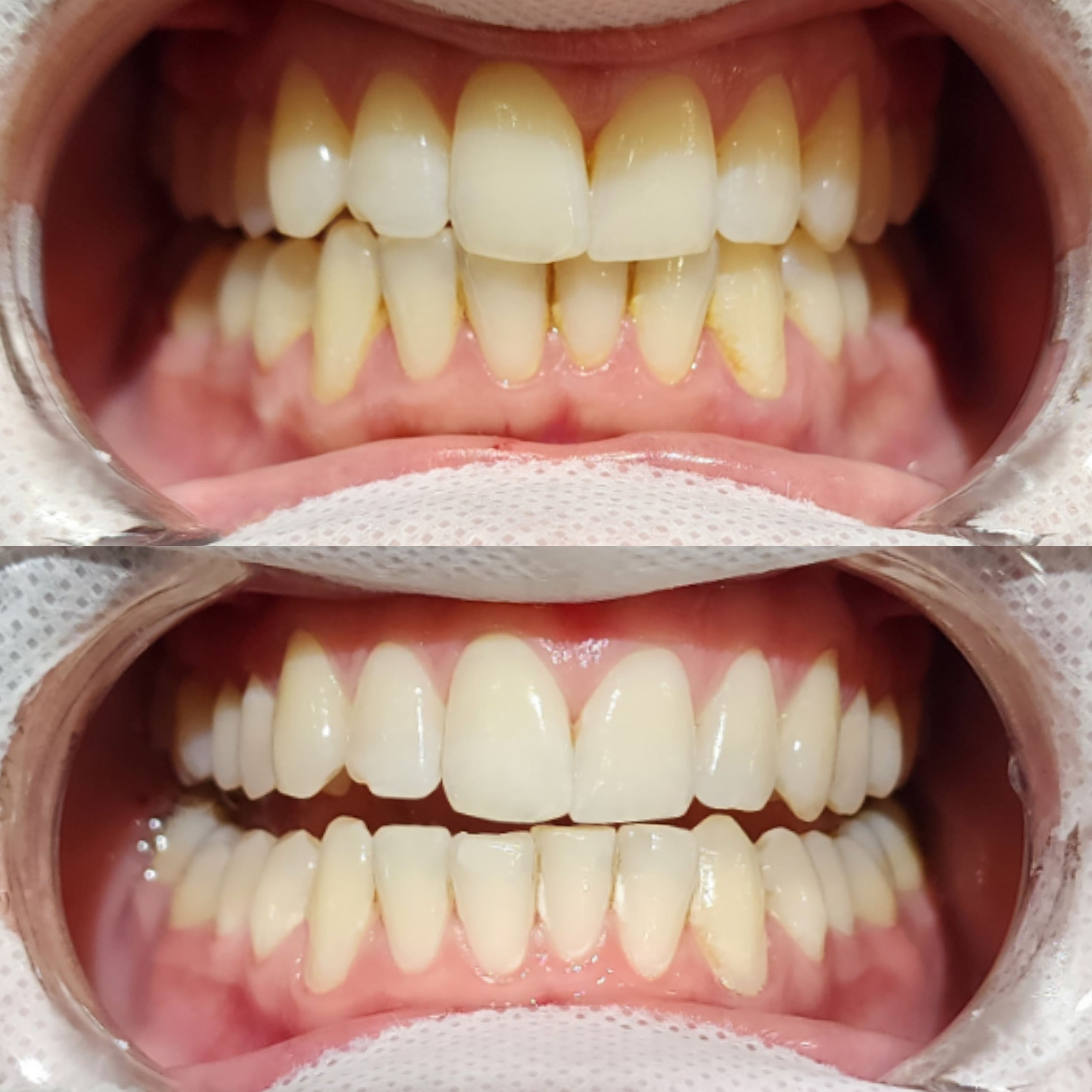 Teeth whitening result 1 at Looks by Brooke