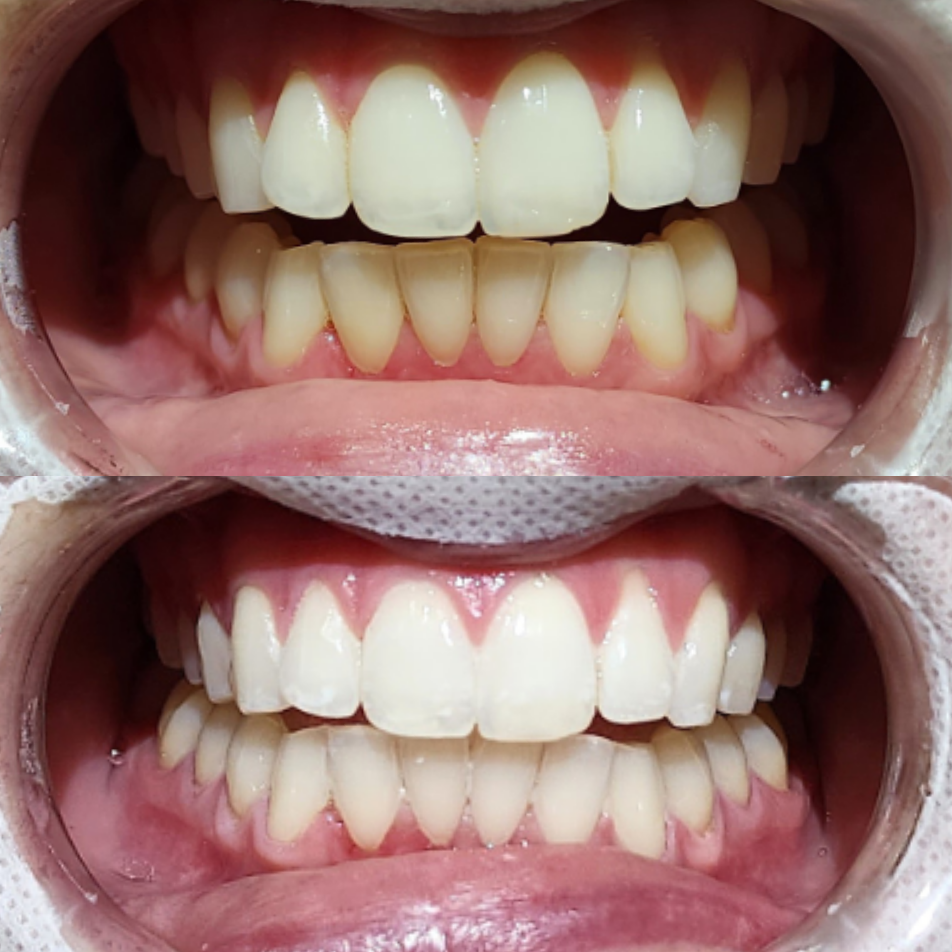 Teeth whitening result 8 at Looks by Brooke