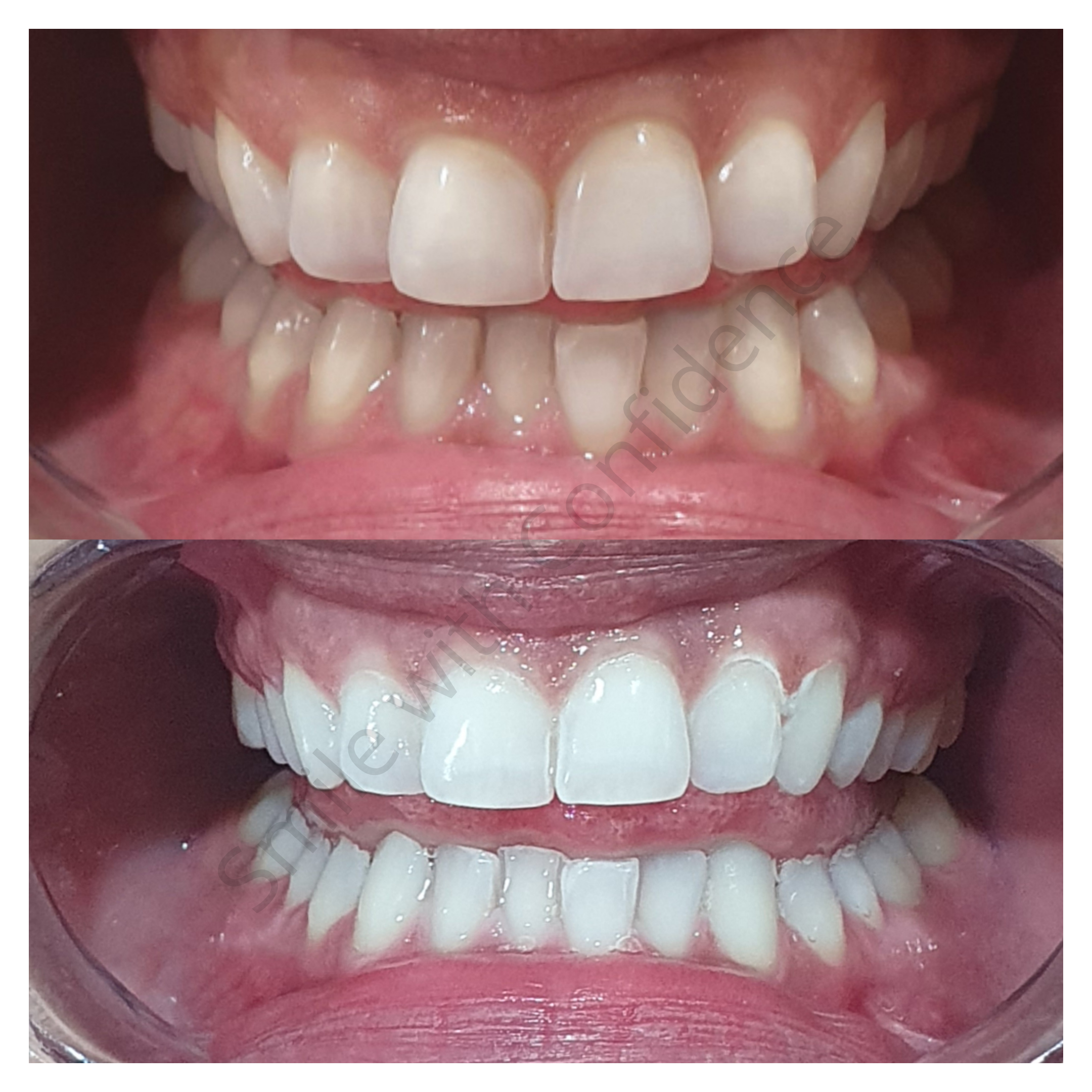 Teeth whitening result 3 at Looks by Brooke