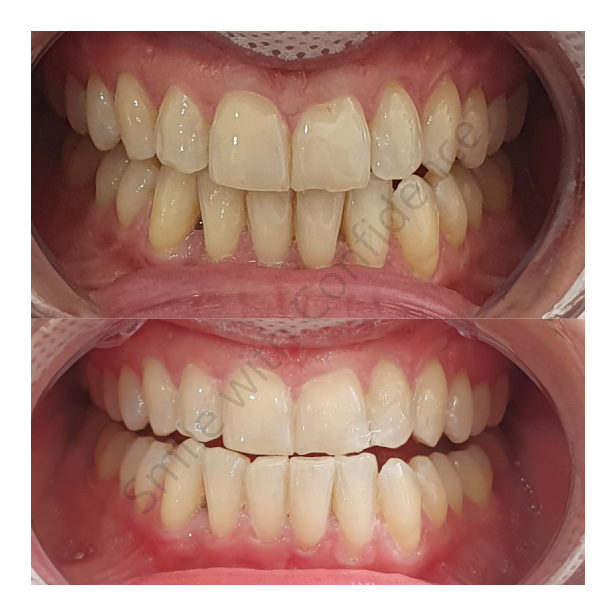 Teeth whitening result 2 at Looks by Brooke